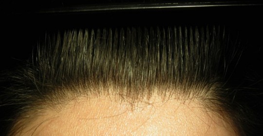 extension alopecia androgenetica